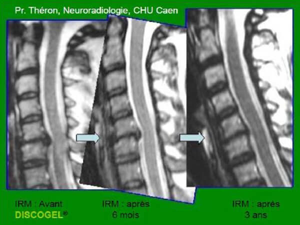 MRI画像による椎間板の変化