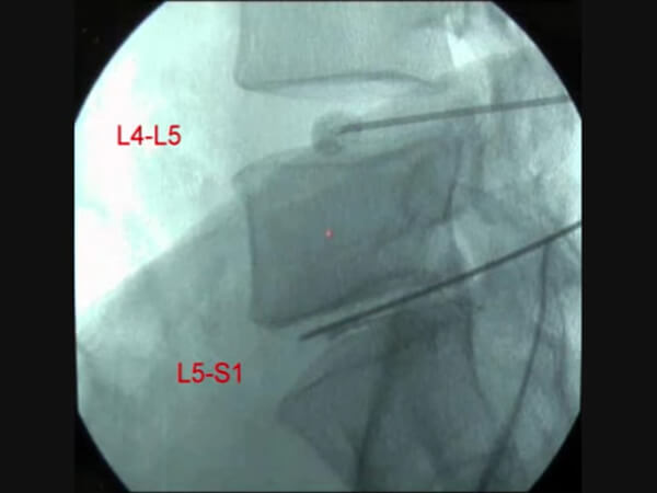 椎間板内に残ったディスコジェル