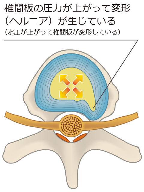 治療方法:局所麻酔下で椎間板内にディスコジェルを挿入します。