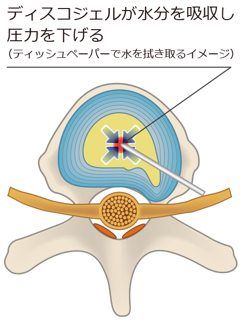 治療方法：椎間板内の水分を吸収して圧力を下げます。